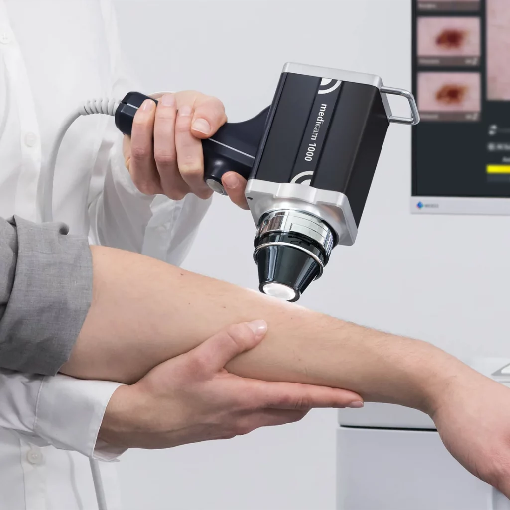 FotoFinder System Medicam1000 Anwendung am Arm eines Patienten