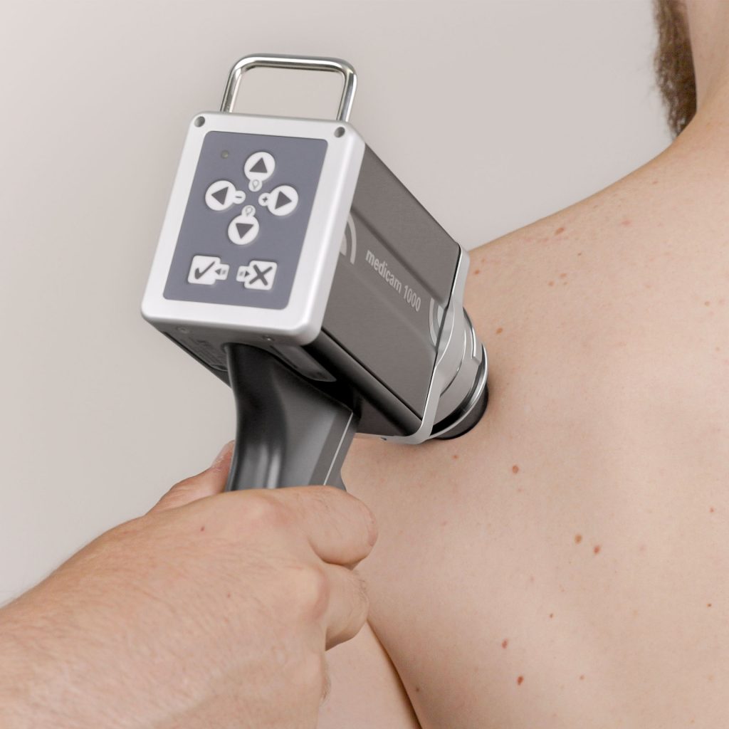 FotoFinder System Medicam1000 Anwendung am Patienten