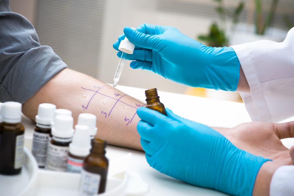 Hautstichallergie, um die Art der Allergie herauszufinden