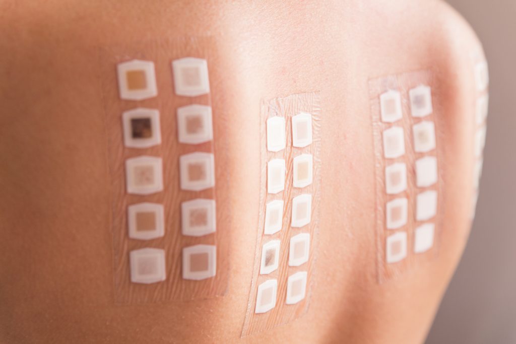 Allergie-Patch-Test auf dem Rücken einer jungen Frau